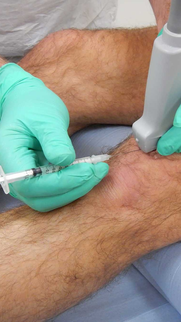 Acid Ultrasound injection 2 Cortisone Injection knee
