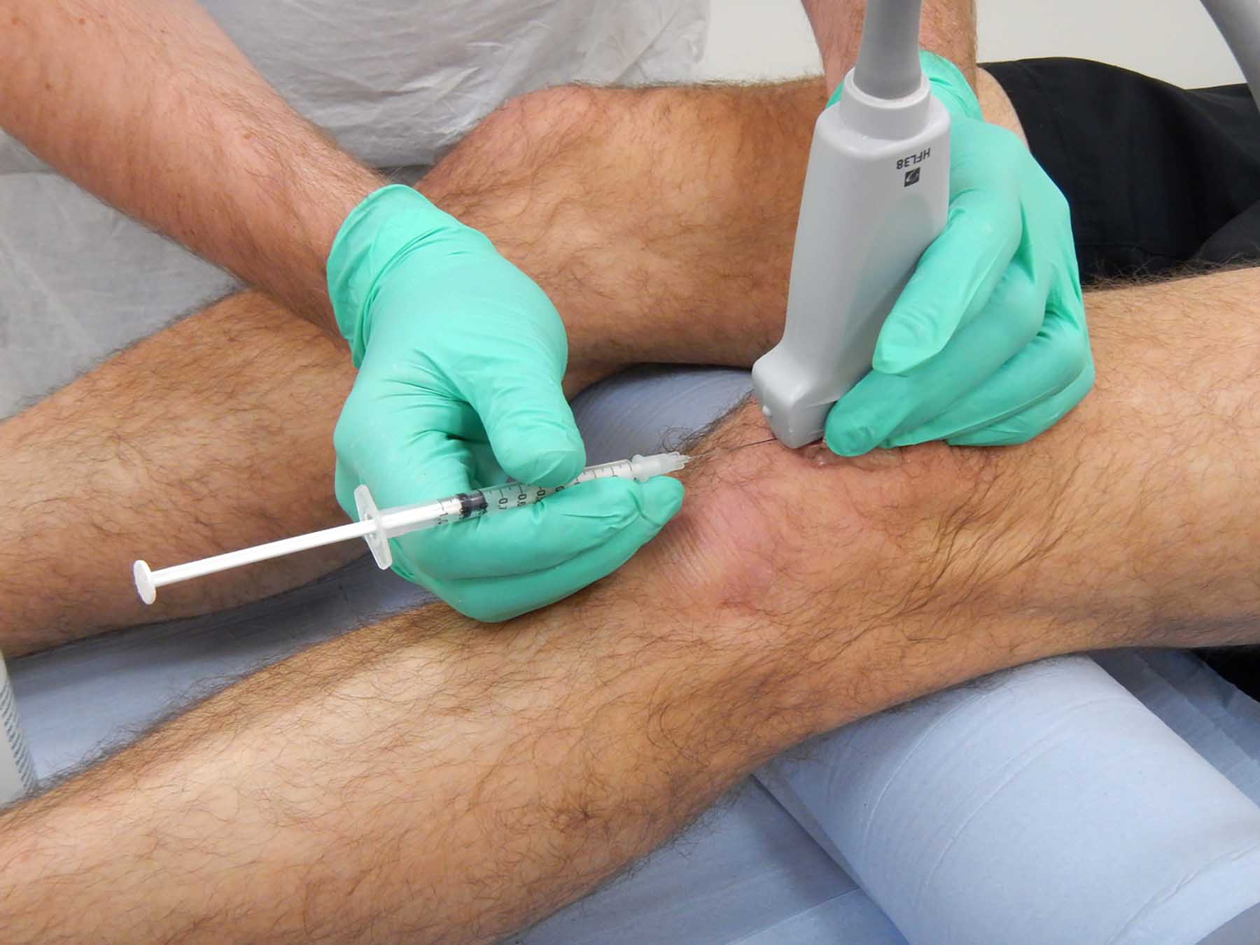 Cortisone Injection knee