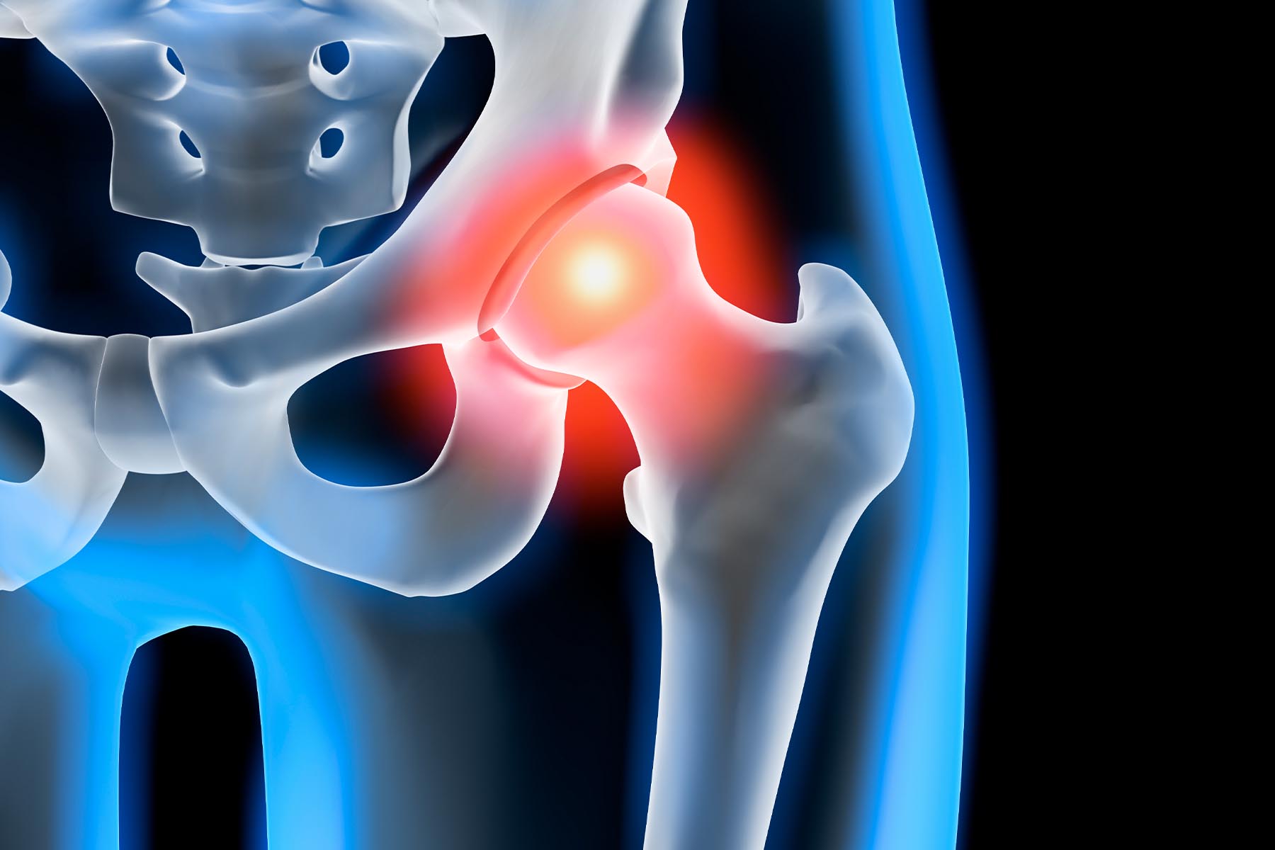 Hip injections. Is there a need for Ultrasound Guidance? 38 ultrasound guided hip injection
