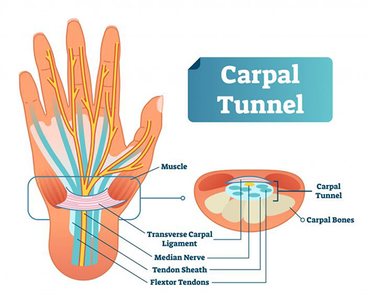 Carpal tunnel syndrome
