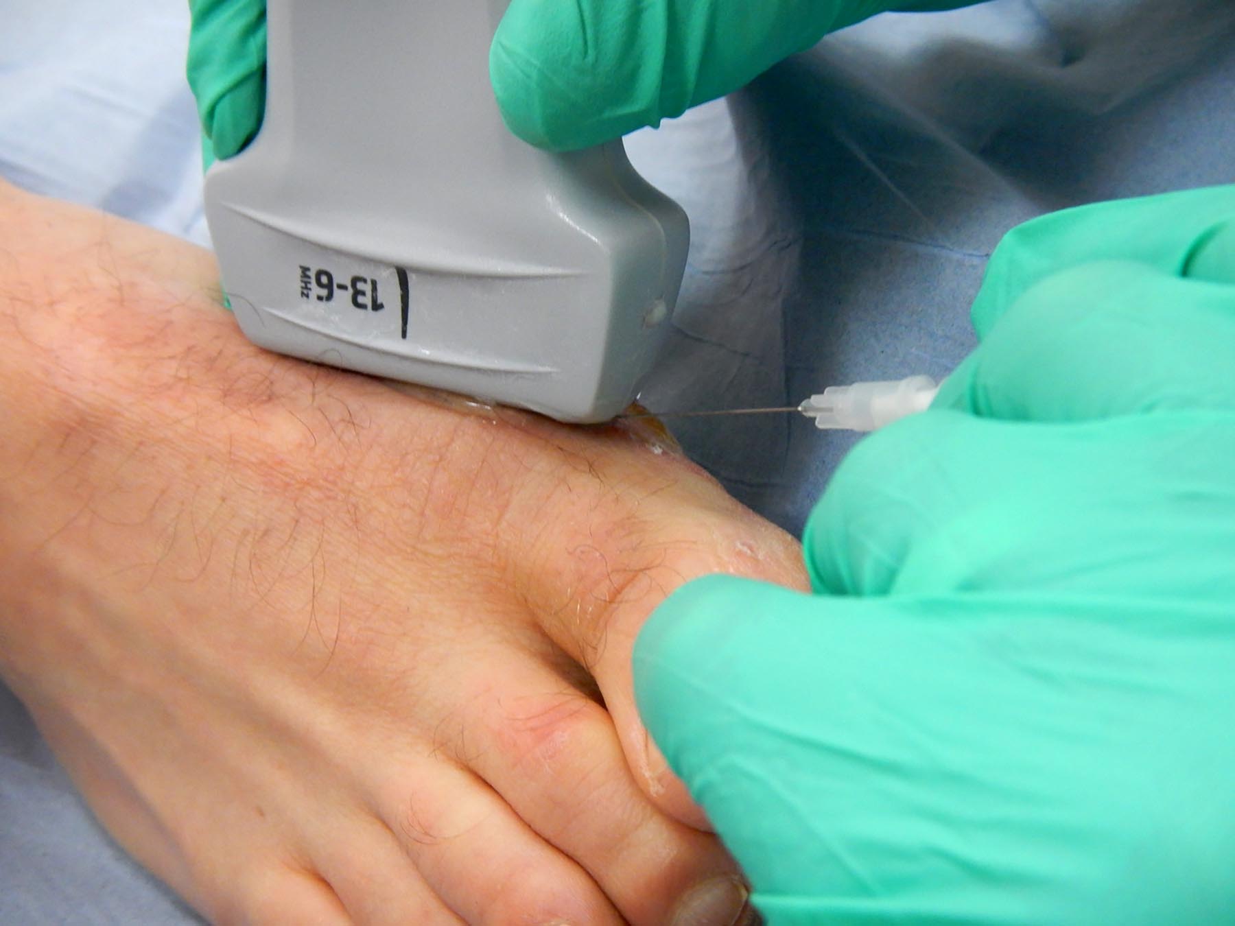 1 Cortisone Injection foot