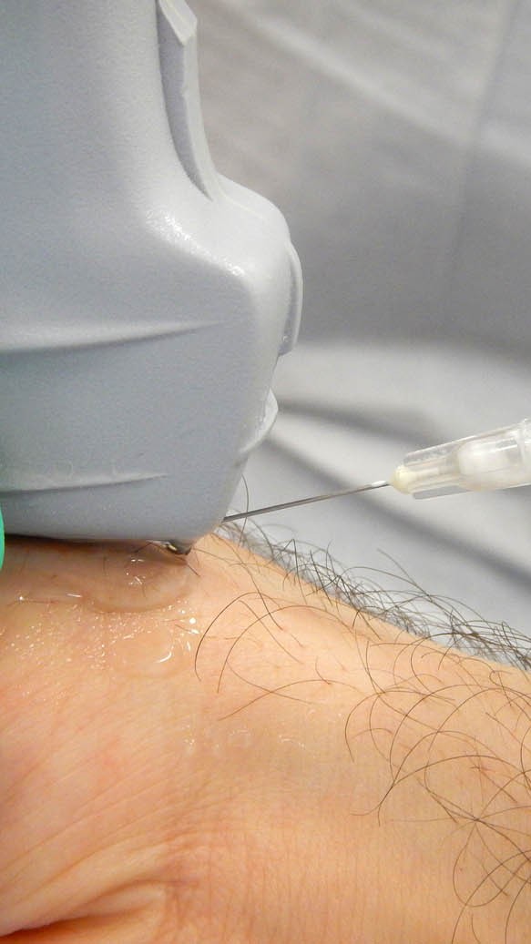 Steroid injection in the wrist at sonoscope clinic