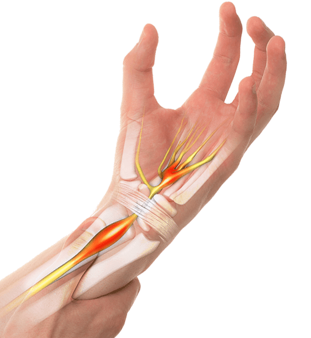 Carpal tunnel syndrome palm up skeletal illustration
