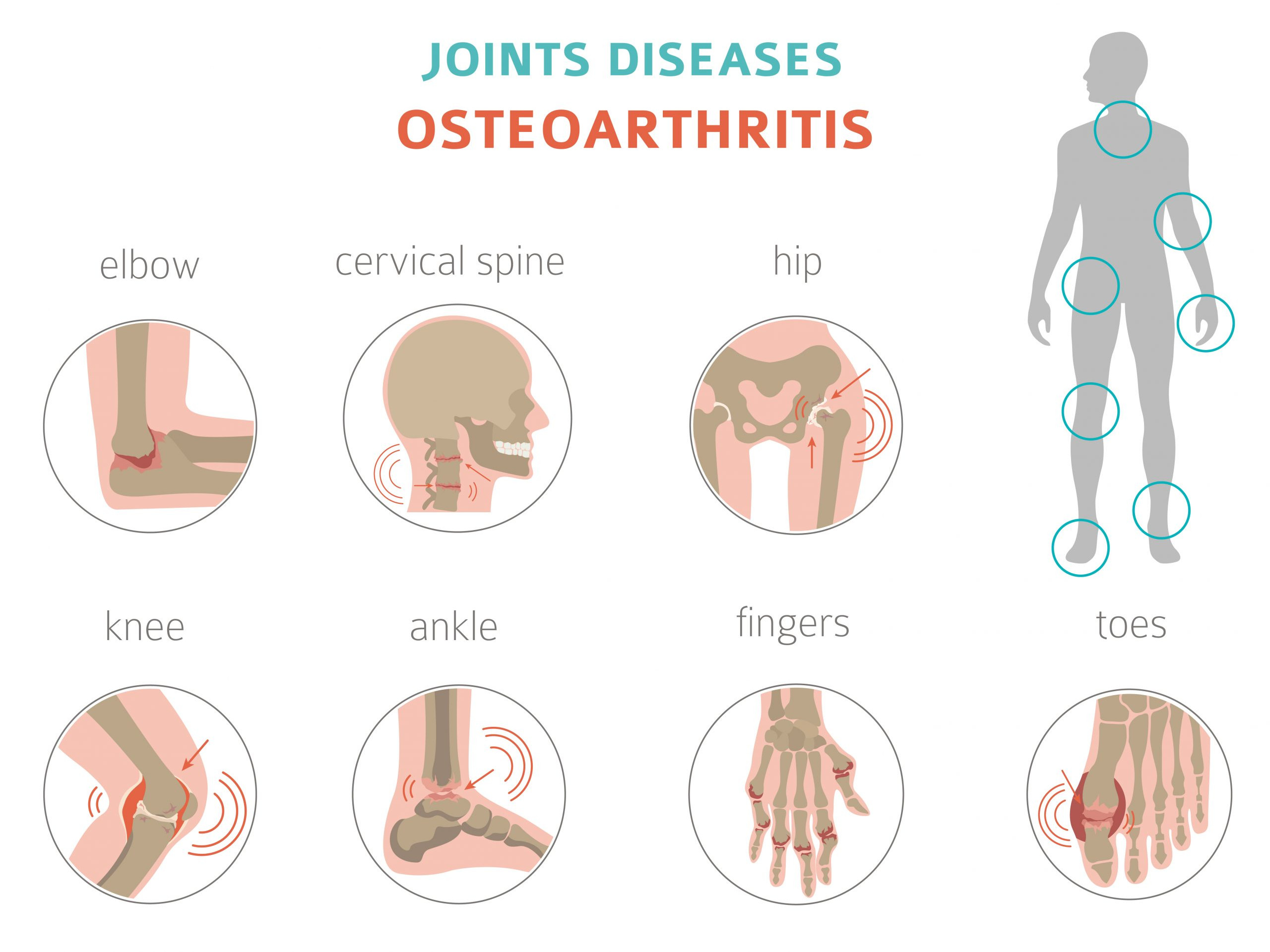 Diagrams representing osteoarthritis of various joints