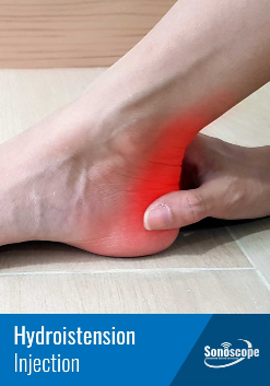 HYDRODISTENSION INJECTIONS 3 achilles pain