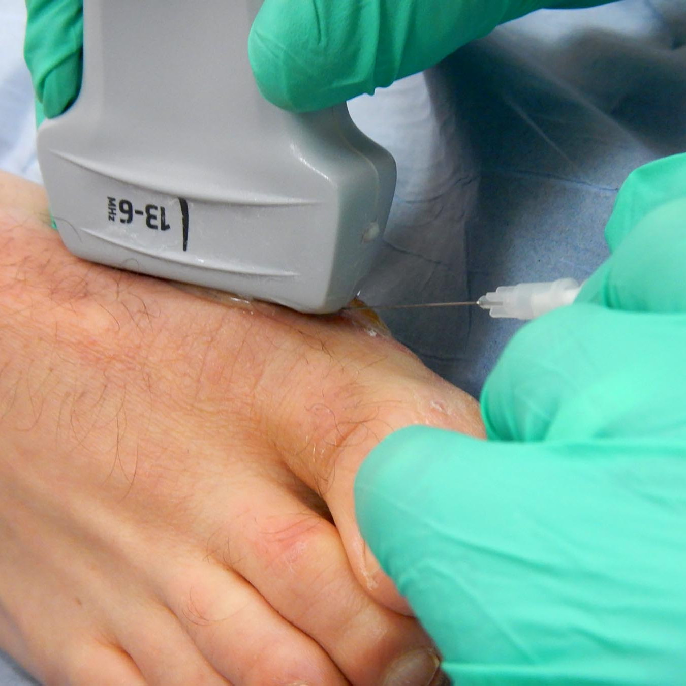 Hyaluronic acid injection for knee, Hyaluronic acid injections knee cost uk, Cortisone injection cost, Shoulder steroid injection, Private cortisone injections near me, Arthrosamid injection uk price, Arthrosamid cost, Private cortisone injections near me