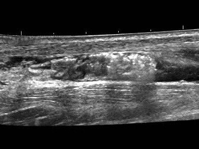 Steroid injection Kenalog, Price of steroid injection, Ultrasound injections, Achilles tendinopathy ultrasound, Fastest acting steroid, Fat dissolving injections knees 5 Steroid injection Kenalog, Price of steroid injection, Ultrasound injections, Achilles tendinopathy ultrasound, Fastest acting steroid, Fat dissolving injections knees