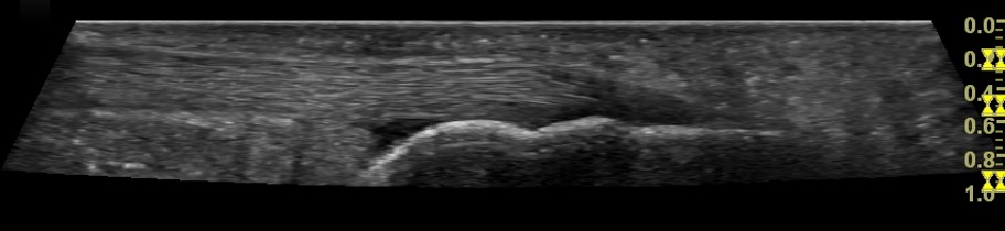 ACHILLES TENDON NORMAAL 2 ultrasound image of achilles tendon normal