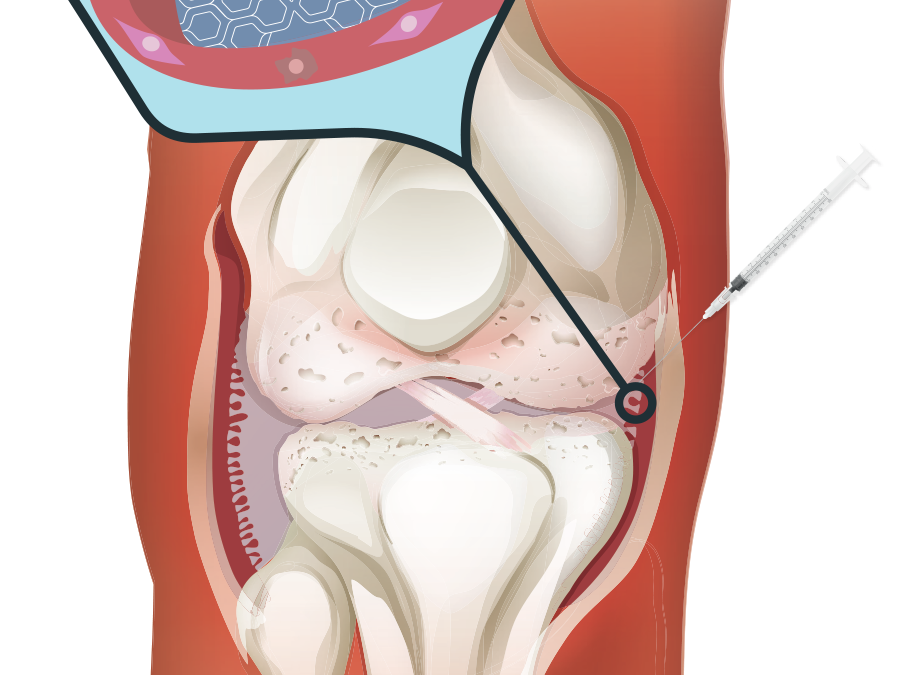 illustration of arthrosamid combining with synovial tissue in the knee