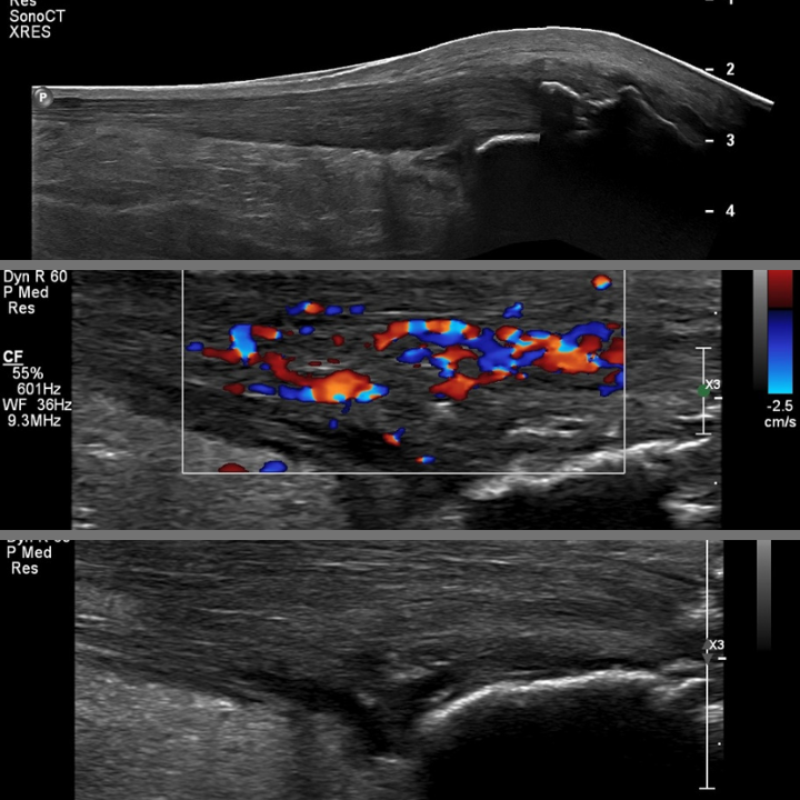 Neovesels 4 multiple neovesels ultrasound images