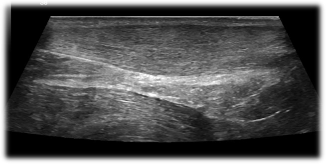 mid achilles tendinopathy 3 ultrasound of mid achilles tendinopathy